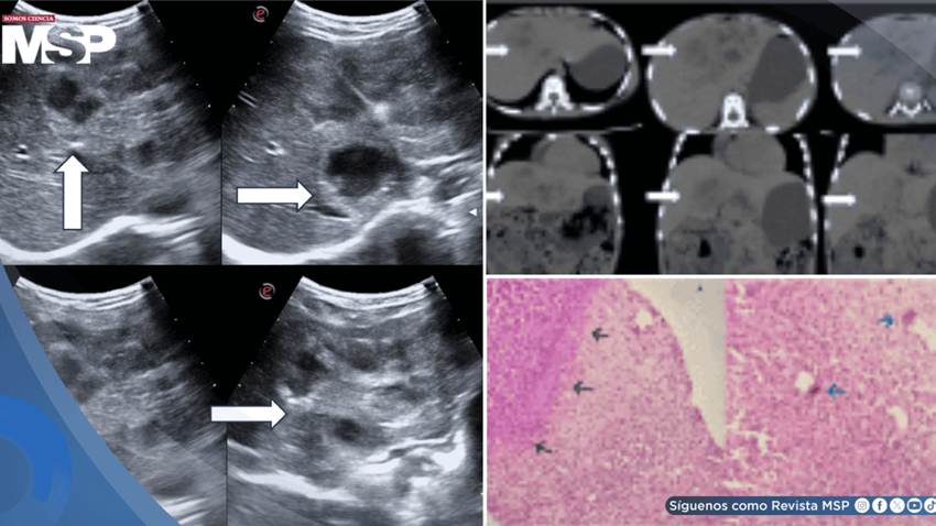 Descubren larva en el hígado de una niña de 8 años: migró desde el intestino y provocó hepatomegalia