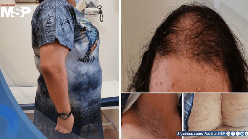 Síndrome HAIR-AN en adolescente con resistencia a insulina e hiperandrogenismo por ovario poliquístico