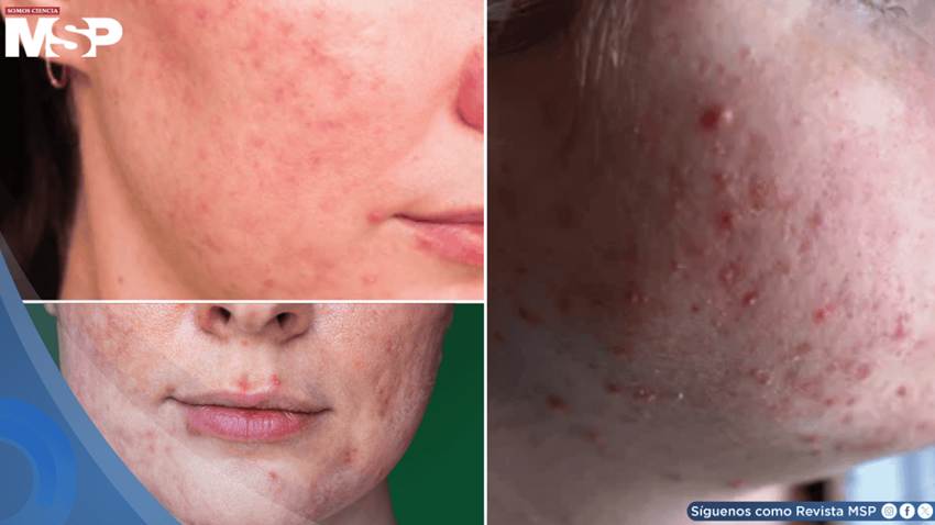 Rosácea papulopustular: brotes inflamatorios se confundirían con acné grave ¿Qué lo desencadena?