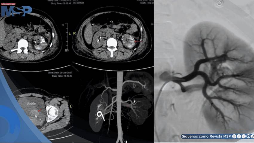 Fístula arteriovenosa renal provocó hemorragia severa y recurrentes en una mujer de 34 años con debilidad