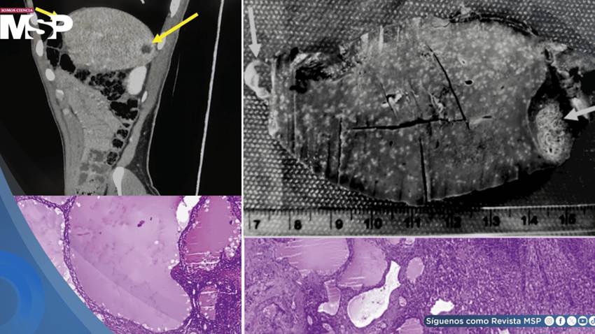 Linfangioma esplénico imitó recaída de cáncer de joven en seguimiento por linfoma tras lesiones en bazo