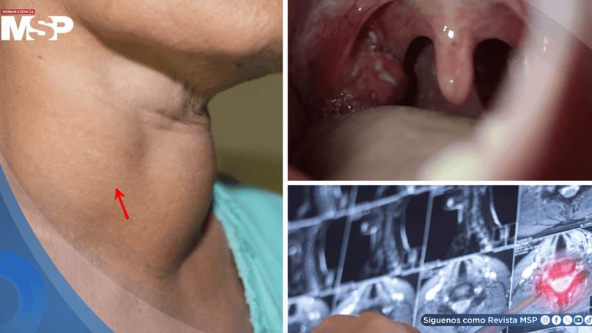 Consumo de vapeadores y alcohol multiplicaría hasta 20 veces el riesgo de cáncer de cabeza y cuello