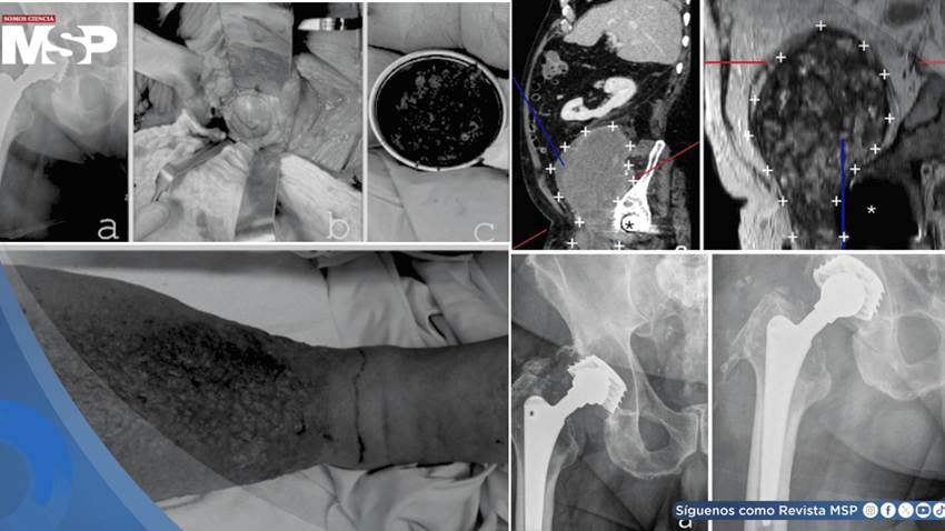 Masa de más de 15 cm secundaria a desgaste de prótesis metal-metal implantada 27 años atrás simuló cáncer