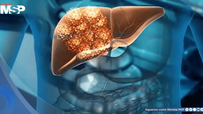 Análisis de sangre predice riesgo de cirrosis o cáncer de hígado hasta 10 años antes con 88% de precisión