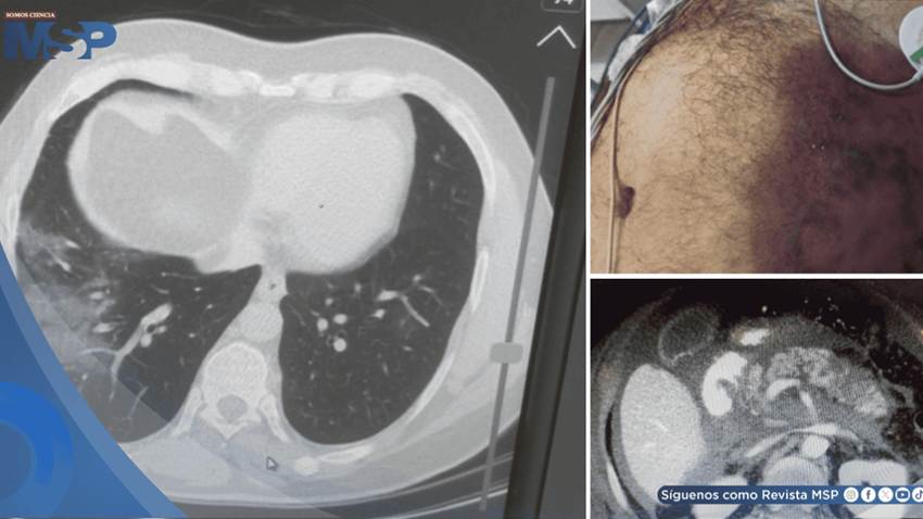 Pancreatitis necrosante como complicación pos-COVID-19 en hombre con shock e insuficiencia multiorgánica