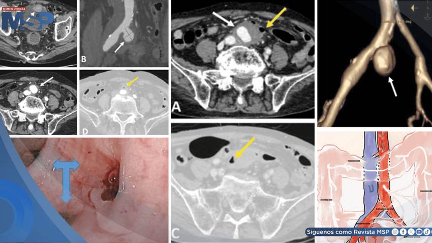 Sangrado intestinal como primer síntoma de aneurisma infectado que perforó el colon de adulto mayor