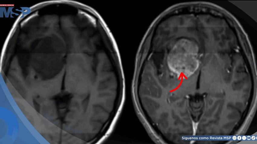 La evolución del papel del oncólogo radioterapeuta en el tratamiento de los gliomas de bajo grado