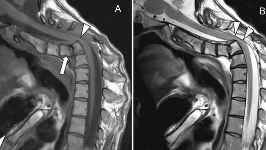 Lesión causada en fisioterapia desencadena luxación cervical completa traumática con cifosis fija
