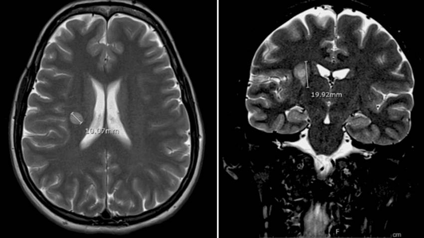 Mujer de 37 años presenta lesión similar a esclerosis concéntrica de Baló con evolución favorable