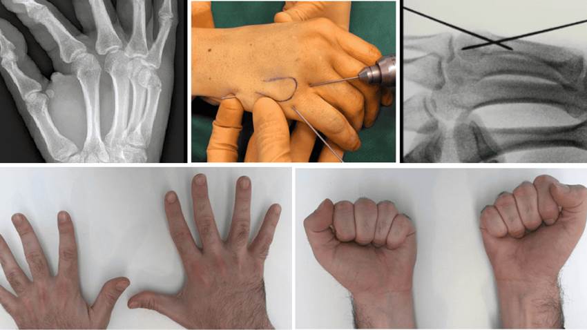 Exitosa técnica minimamente invasiva para tratar fracturas de metacarpianos con 3 agujas de Kirschner