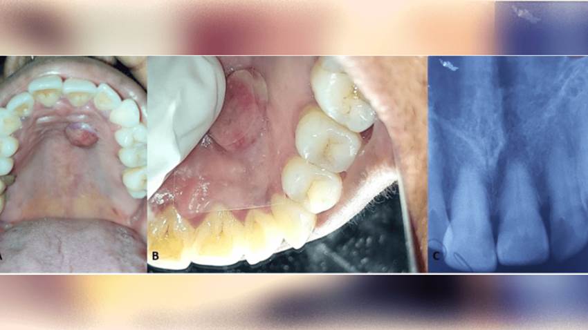 Éxito en tratamiento con láser de un hemangioma capilar en cavidad oral de paciente femenina