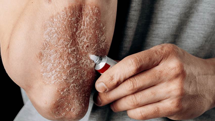 Plataforma digital como herramienta de enfermería en manejo integral de psoriasis y artritis psoriásica