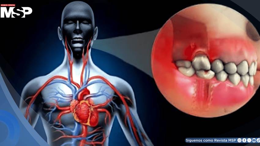 Bacterias bucales podrían migrar a las arterias, causar inflamación y aumentar el riesgo de infarto
