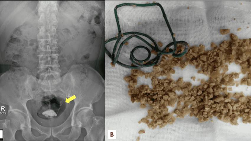Stent D-J no retirado se convierte en el núcleo de un cálculo vesical causando hidronefrosis