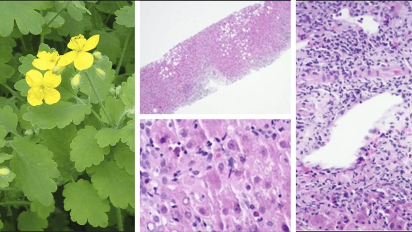 Hombre desarrolla daño hepático y fibrosis por consumo de celidonia mayor y suplementos dietéticos
