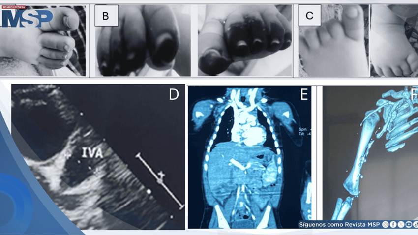 Vasculitis sistémica y necrosis digital revelan enfermedad de Kawasaki en un lactante de cuatro meses