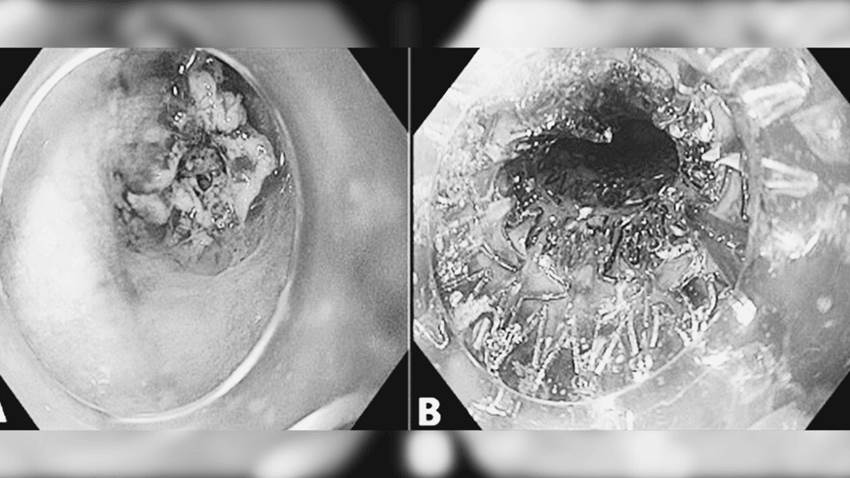 Paciente con cáncer de esófago desarrolla fibrilación auricular tras colocación de un stent esofágico