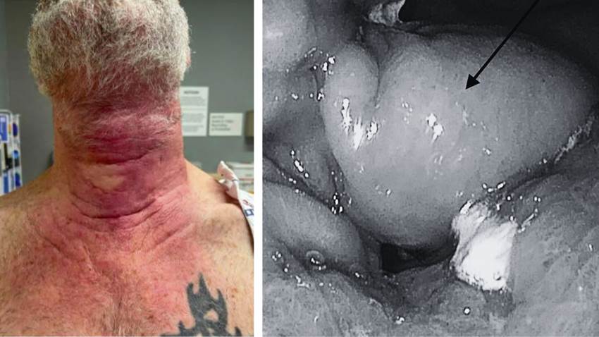 Paciente presenta rara metástasis cutánea de cáncer gástrico con células en anillo de sello