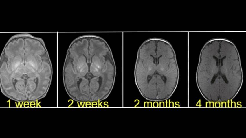 Complicación por anormalidad uterina: bebé sufre parálisis cerebral tras parto prematuro y asfixia grave