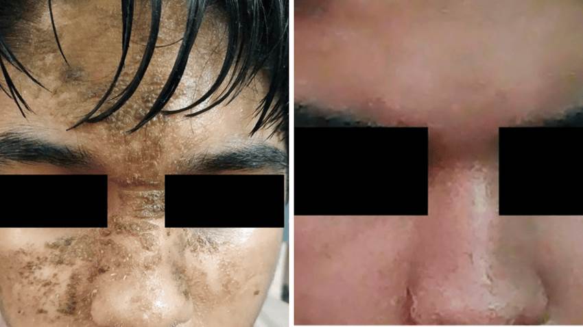 Psicodermatología: Dermatitis neglecta como manifestación cutánea del trastorno obsesivo-compulsivo
