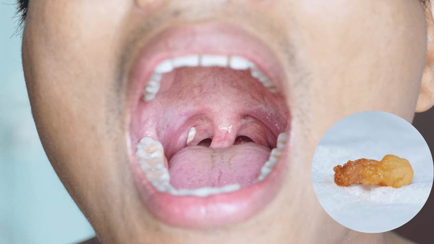Tonsilolitos o piedras en las amígdalas: causas y tratamientos