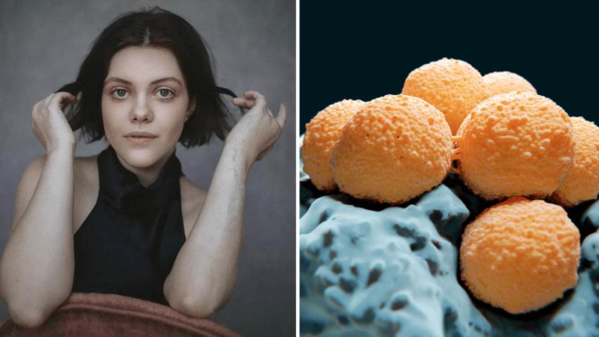 Fascitis Necrosante, la enfermedad carnivora que sufrió la actriz Georgie Henley