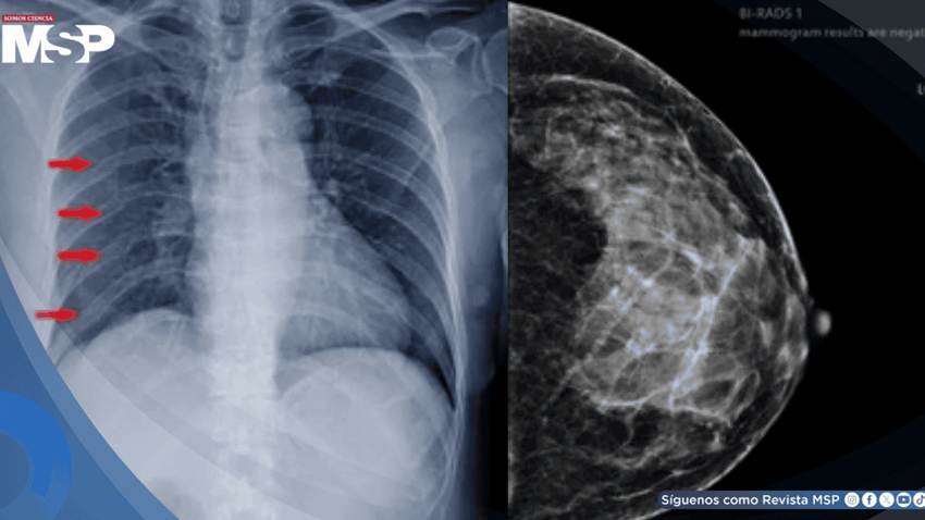 Múltiples fracturas costales por osteorradionecrosis como secuela de la reirradiación por cáncer de mama