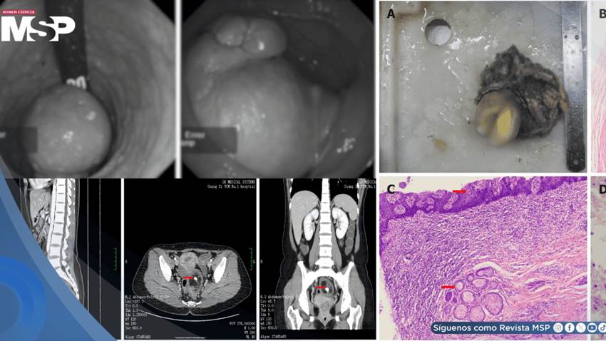Masa rectal con tejido óseo y cerebral en mujer gestante es causada por un teratoma rectal maduro