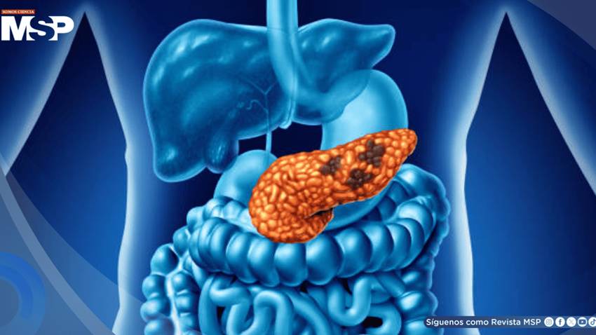 Microplásticos en el agua podrían relacionarse con daño pancreático y favorecer la diabetes