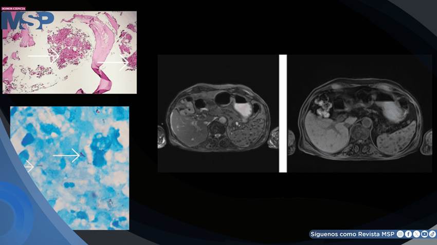 Tuberculosis extrapulmonar infiltró la médula ósea y provocó pancitopenia severa en adulto mayor
