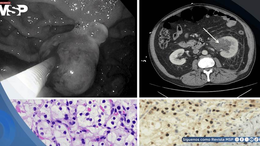 Metástasis gástrica permitió detectar cáncer en el riñón en paciente de 65 años con fibrilación auricular