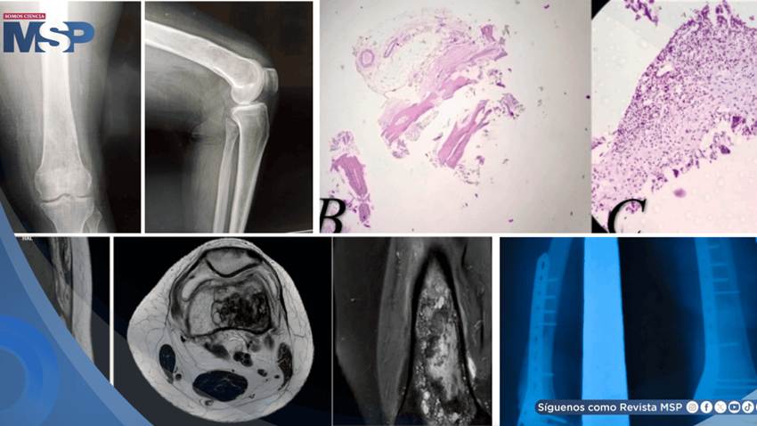 Dolor de rodilla por lo que parecía un quiste benigno, resultó ser una infección parasitaria del hueso