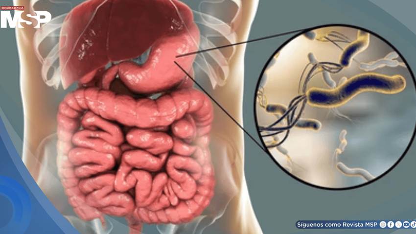 La erradicación de H. pylori reduce riesgo de cáncer gástrico en todas las edades, incluso en mayores