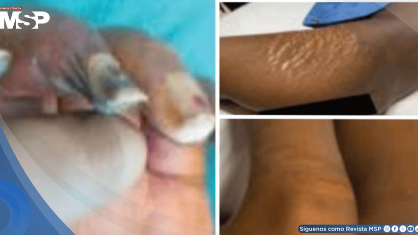 Niña de 9 años con artritis idiopática juvenil de inicio sistémico desarrolló grave gangrena periférica