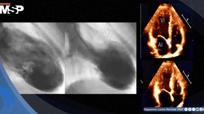 Síndrome de Takotsubo: Infarto miocardio por estrés emocional en mujer con hipertensión e hipotiroidismo