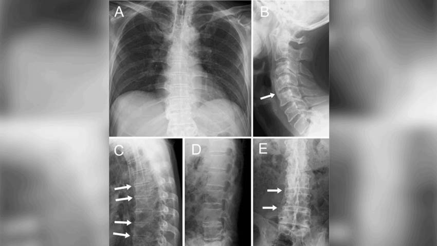Espondilitis anquilosante se presenta con rara entesitis en localización infrecuente y fiebre