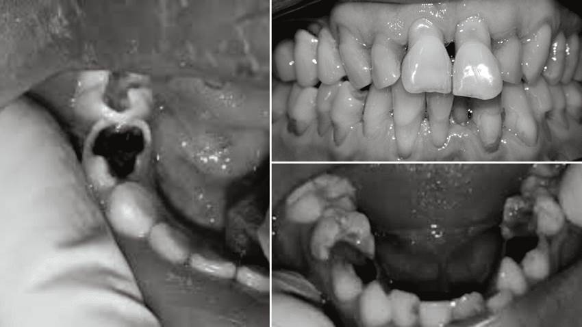 Importancia de la alfabetización bucodental y la prevención de afecciones bucales, según estudio