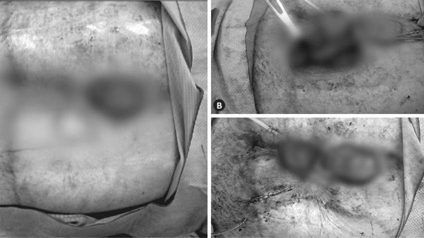 Exitoso cierre de fístula con colgajo miocutáneo en mujer con mutación de factor V de Leiden