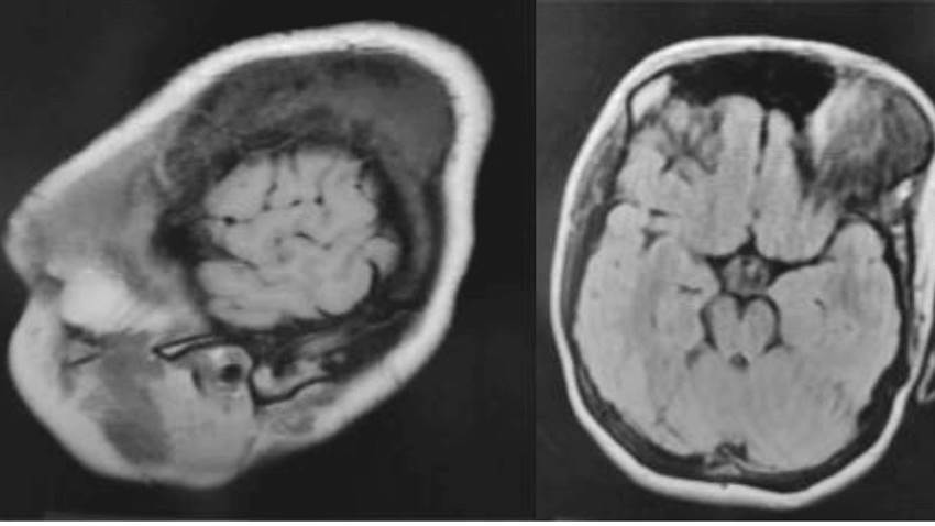 Detectan osteoma craneal en joven con dolor de cabeza tras 18 años de un traumatismo craneoencefálico
