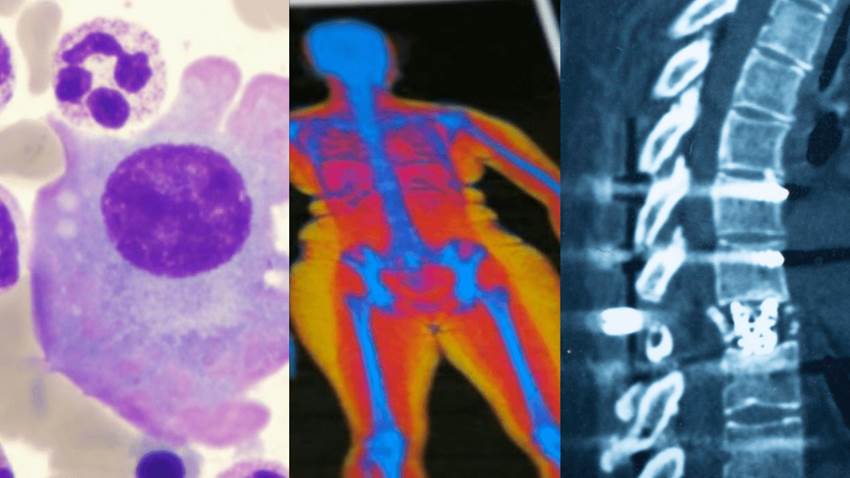 Obesidad aumenta la capacidad de proliferación del cáncer en pacientes con mieloma múltiple