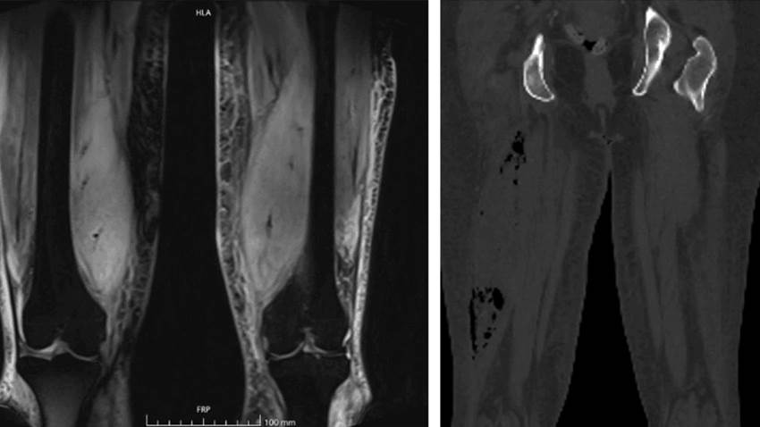 Describen raro caso de mionecrosis diabética complicada con piomiositis y absceso por E. Coli