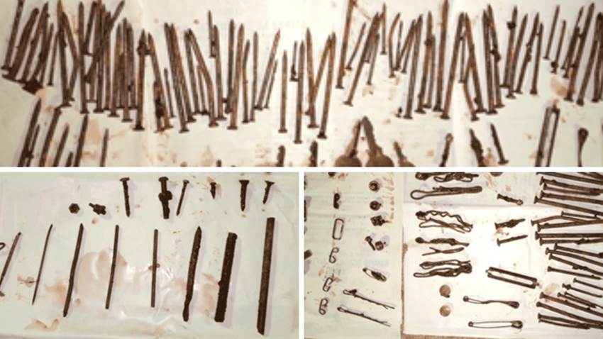 Mujer ingresa a urgencias con 170 piezas metálicas que ingirió en una crisis de esquizofrenia