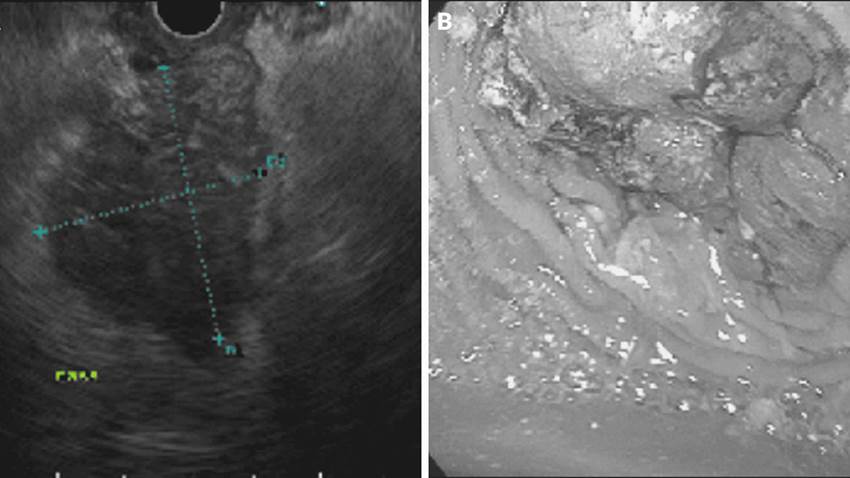 Cáncer de colon se presenta mediante cetoacidosis diabética por metástasis pancreática en etapa avanzada