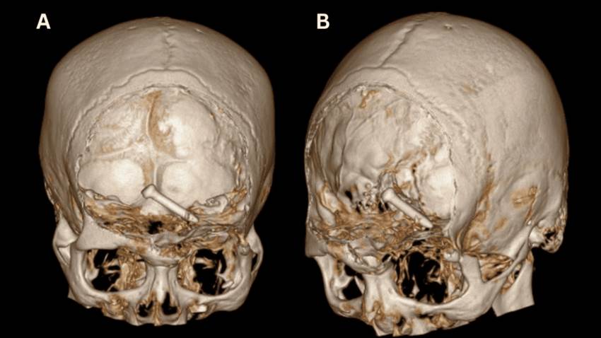 Hombre sobrevive a un clavo alojado en el cerebro tras accidente laboral con pistola de clavos