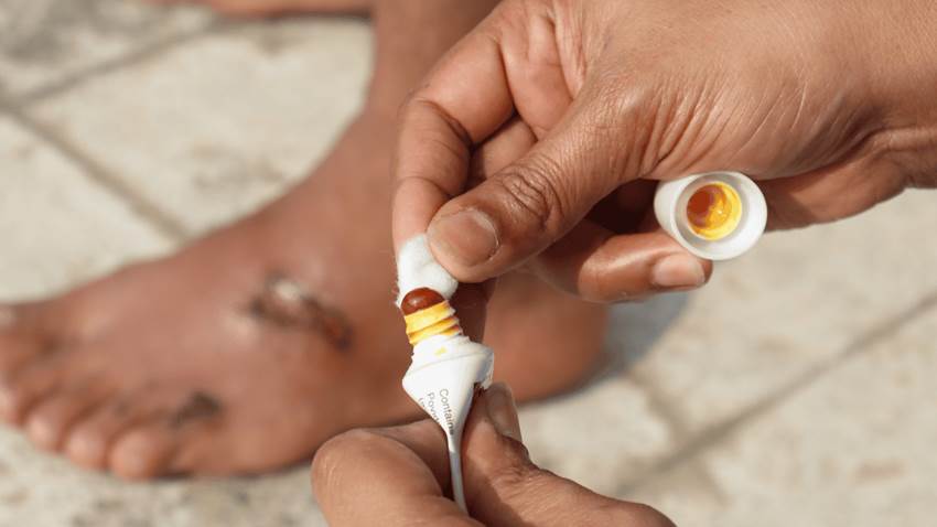 Desarrollan nuevo tratamiento con hidrogel para úlceras y heridas de difícil cicatrización