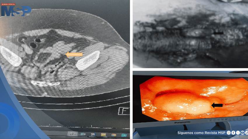 Dolor abdominal persistente terminó revelando un lipoma gigante en el colon sigmoide