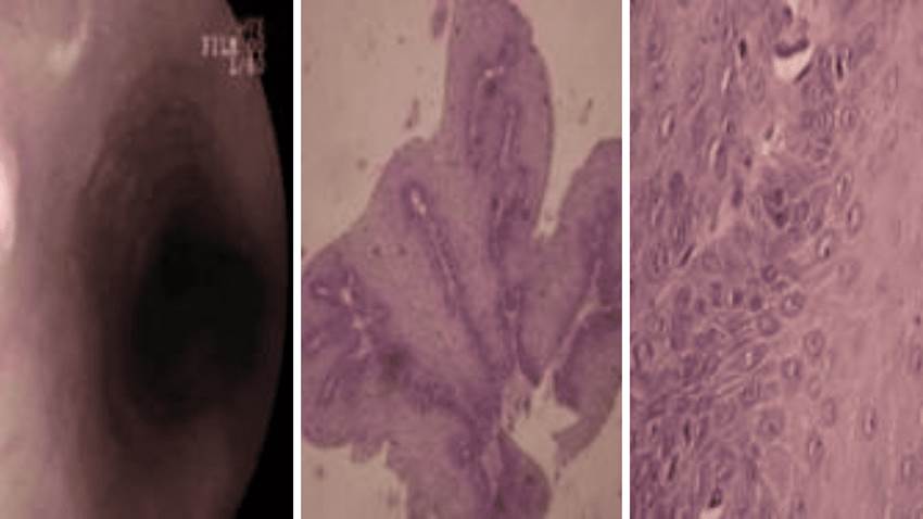 Paciente es diagnosticado con rara papilomatosis esofágica por VPH tras presentar regurgitaciones ácidas