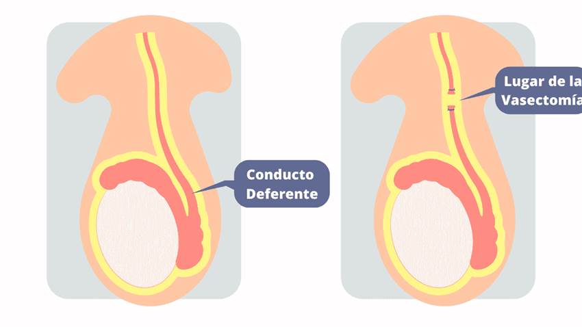 Aumentan significativamente las vasectomías en Puerto Rico