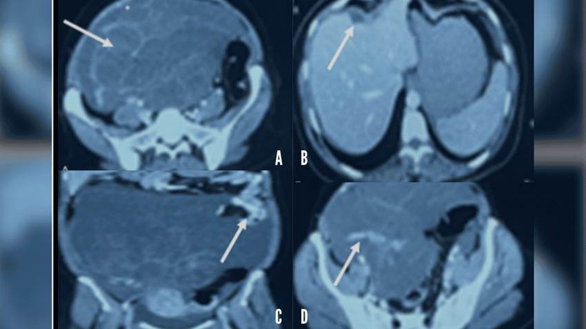 Reportan inusual hallazgo de pseudomixoma peritoneal o 