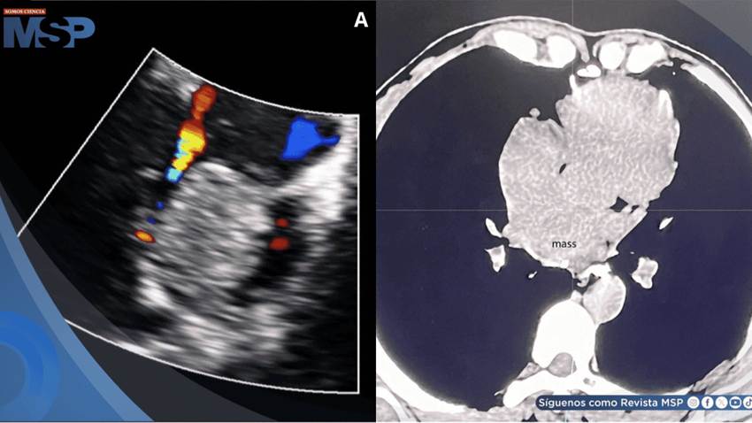 Detectan raro tumor cardíaco maligno en paciente con síntomas comunes de cardiomiopatía
